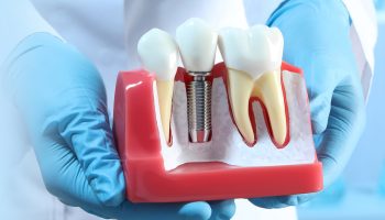 How Long is the Process of Tooth Implant?