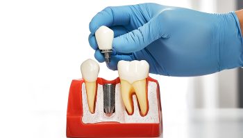 Understanding in Detail the Role of the Abutment in Dental Implants