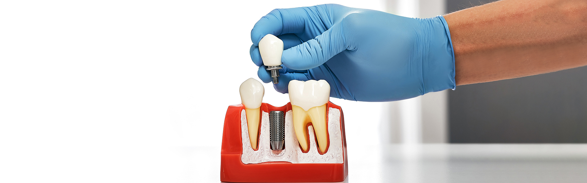 Understanding in Detail the Role of the Abutment in Dental Implants