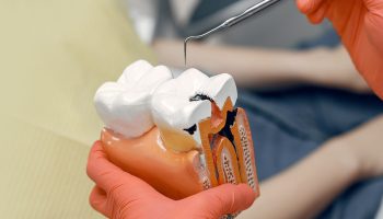 How Root Canal Treatment Helps Relieve Severe Tooth Pain Quickly